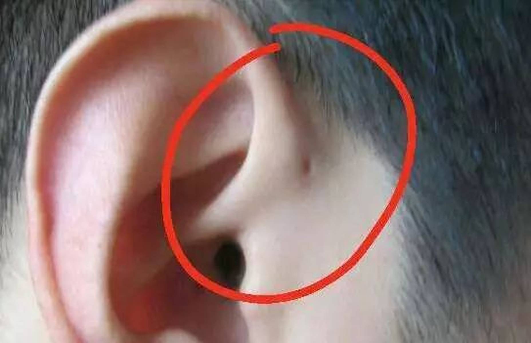 耳朵上的这个小洞千万别挤