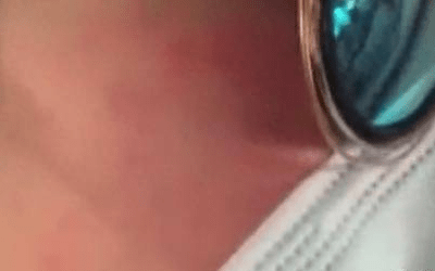 男子撸铁后擦汗 脸部感染脚气